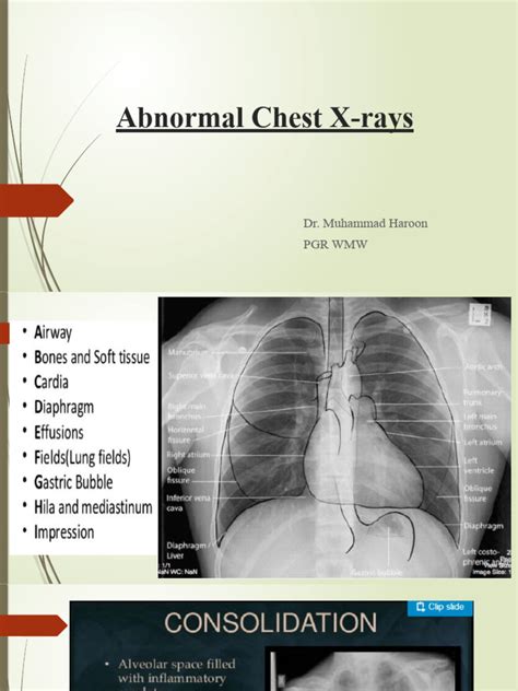 Understanding Apmlitude In Xrays: How Subtle Signals Reveal Disease
