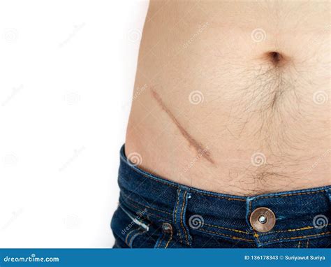 Hidden Mysteries of the Appendicitis Scar