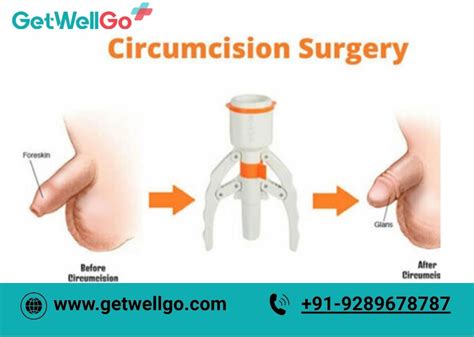 Baby Circumcision Benefits Risks And What To Expect