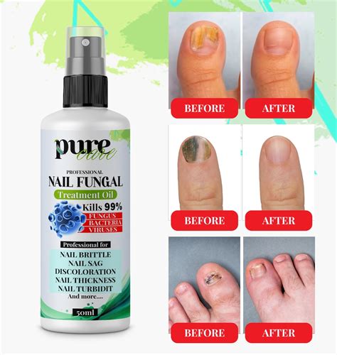 Best Toe Nail Fungus Treatment