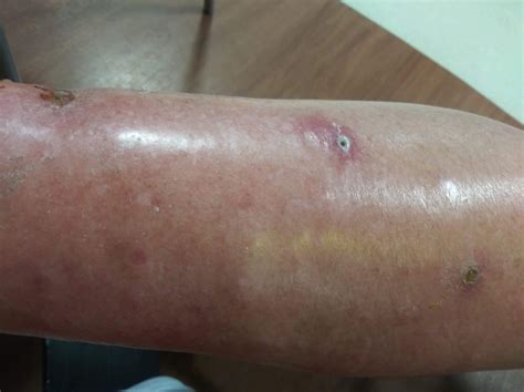 Cellulitis Flesh Eating Bacteria