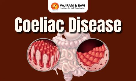 Coeliac Disease Wikipedia