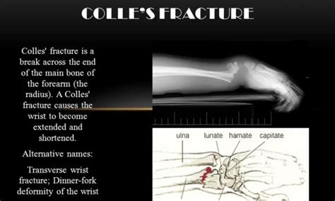 Colles Fracture Causes Presentation And Management Kenhub
