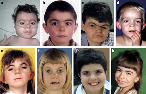 Cornelia De Lange Syndrome Causes Symptoms Diagnosis Treatment