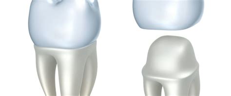 Do Endodontists Do Temporary Crowns