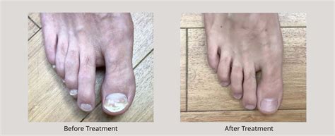 Do Over The Counter Toenail Fungus Treatments Work
