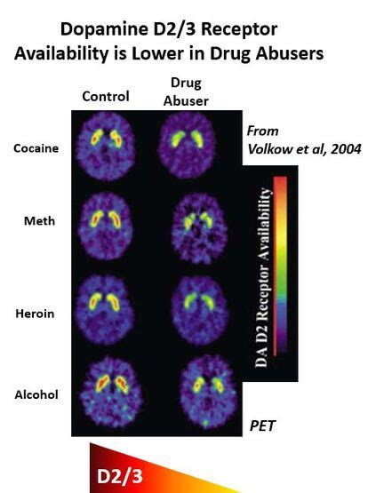 Dopamine Drug Addiction Personalized Medicine Christopher T Smith Com