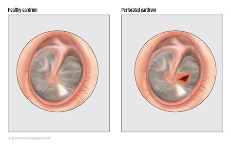 Healing Eardrum Scar: Effective Treatment Options