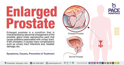 Discover Early Signs of Prostate Enlargement Symptoms You Shouldn't Ignore