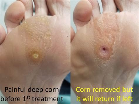 How Remove Corn On Foot Hotsell Emergencydentistry Com