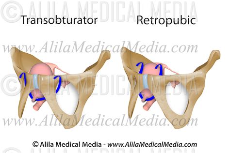Midurethral Sling Breakthrough: Understanding the Latest Advances in Stress Incontinence Treatment