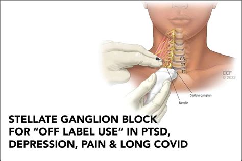 Stellate Ganglion Block Ptsd