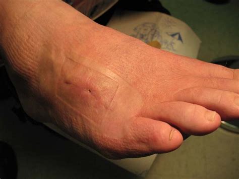 Stingray Sting Foot