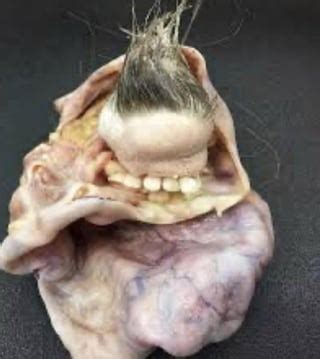 This Is What A Teratoma A Tumor That Can Grow Teeth Eyes Hair Etc Looks Like I Had A Friend Who Had One Of These Little Guys Wrapped Around Her