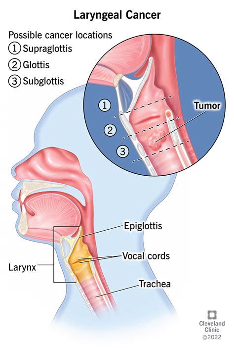 Throat And Laryngeal Cancers Moffitt