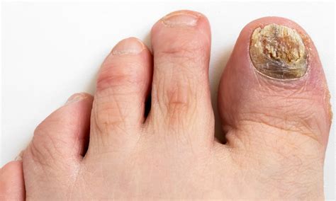 Toenail Fungus What Is It How To Prevent And Treat It Nyc