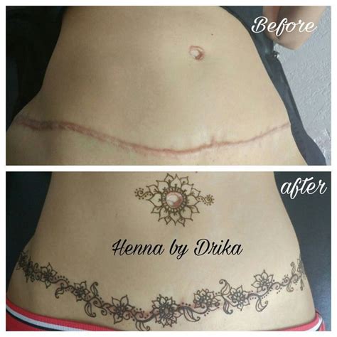 Tummy Tuck Scar Tattoo Ideas Watercolor Tattoo Design Tummy Tuck Scar Tattoo Ideas Watercolor Tattoo Design