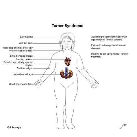 Turner Syndrome Concise Medical Knowledge
