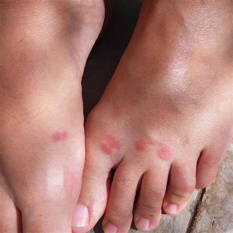 What Does A West Nile Virus Mosquito Bite Look Like