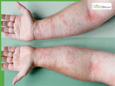 Winter Itch What Causes It And How To Prevent It Thehealthsite Com